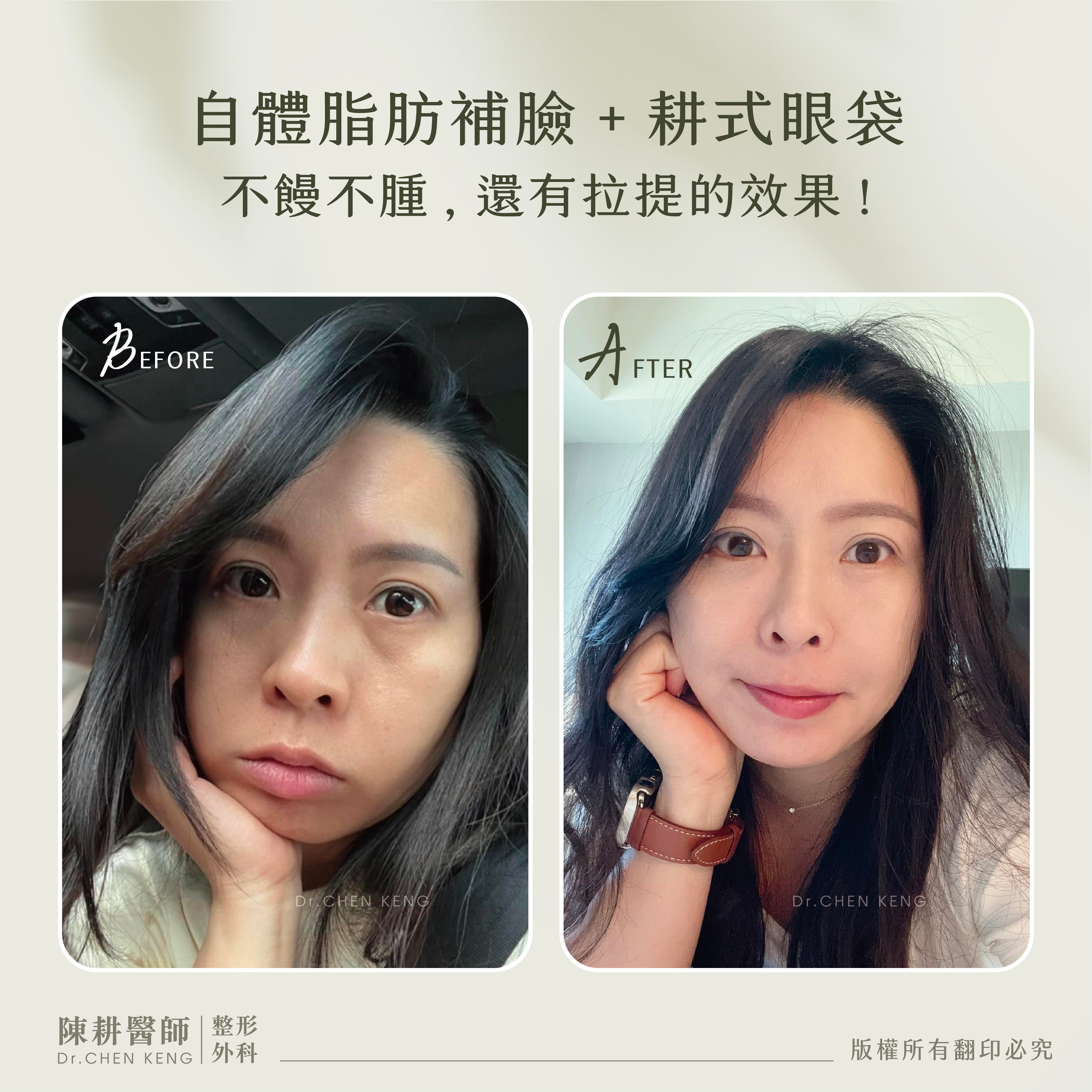 淚溝補脂