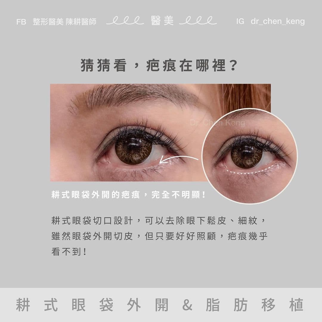 眼袋外開疤痕