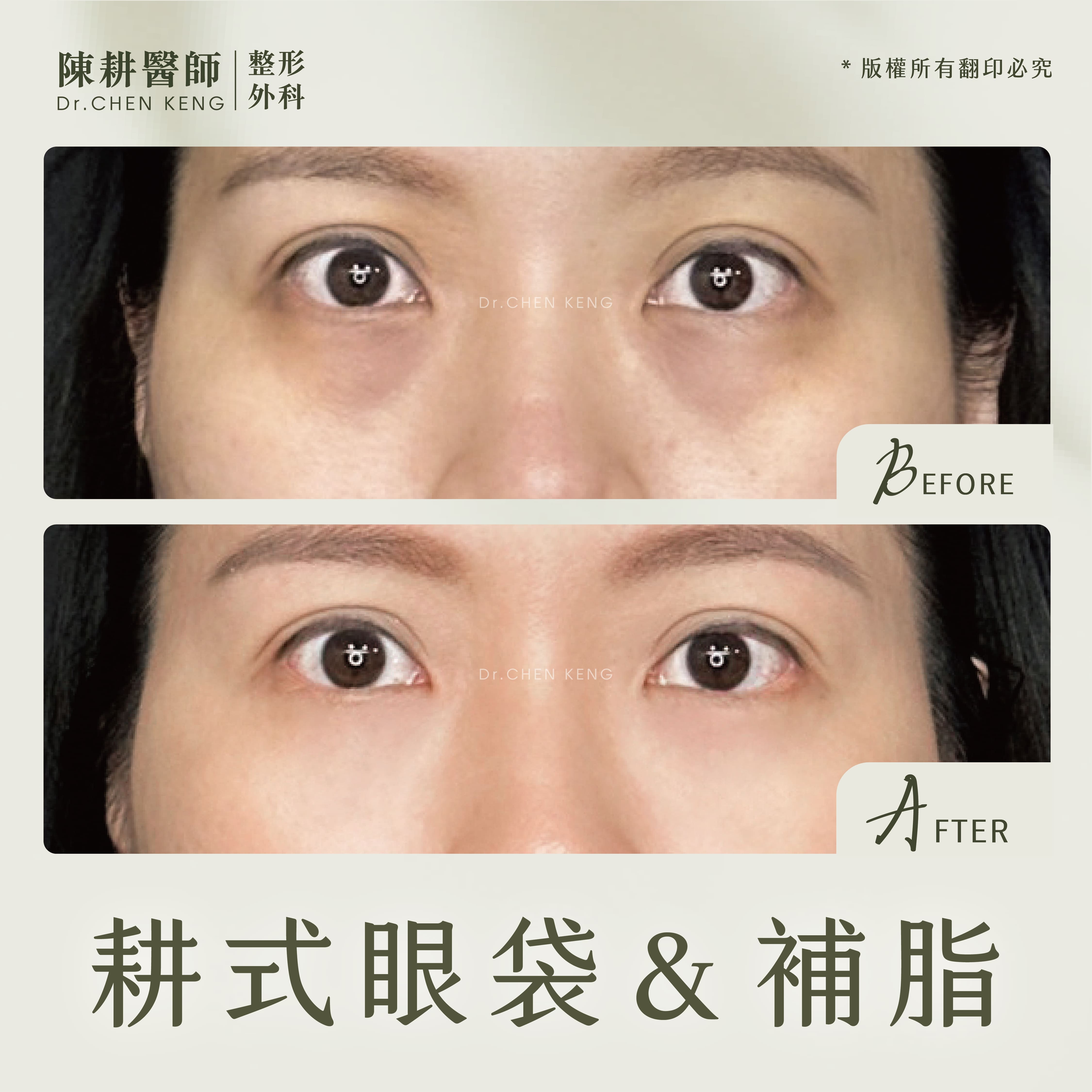 眼袋內開補脂
