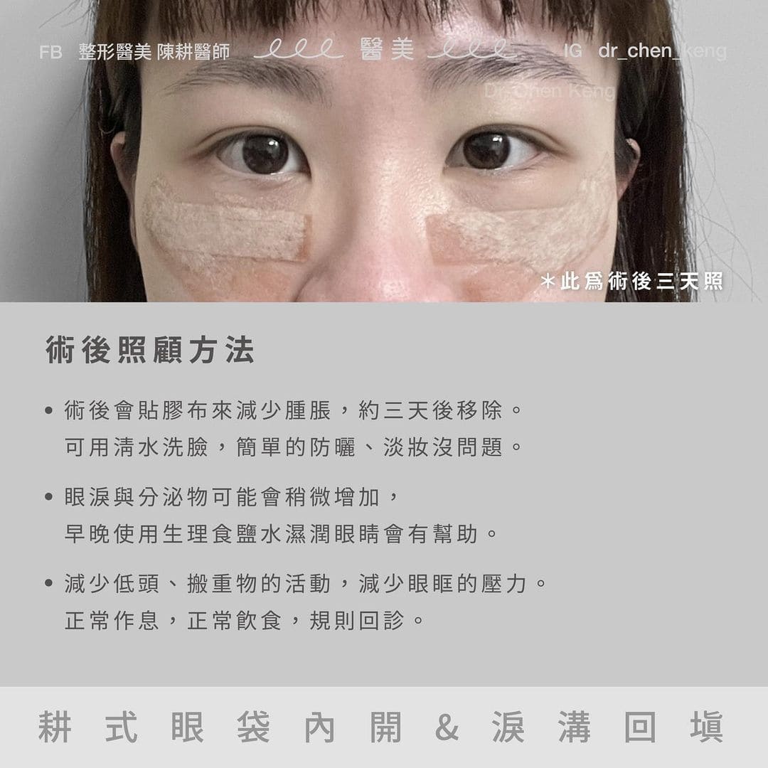 眼袋術後照顧