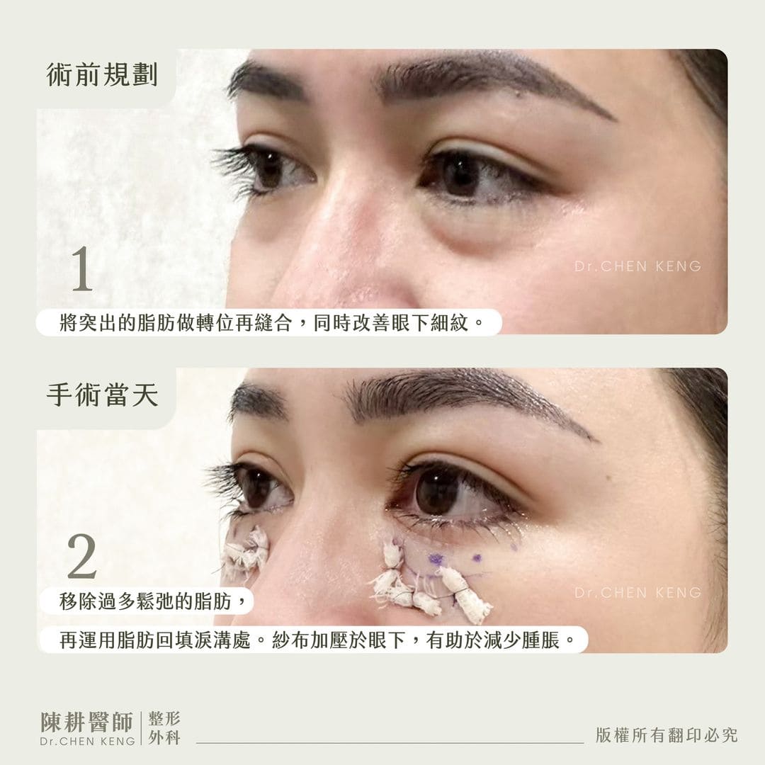 眼袋內開淚溝回填術後