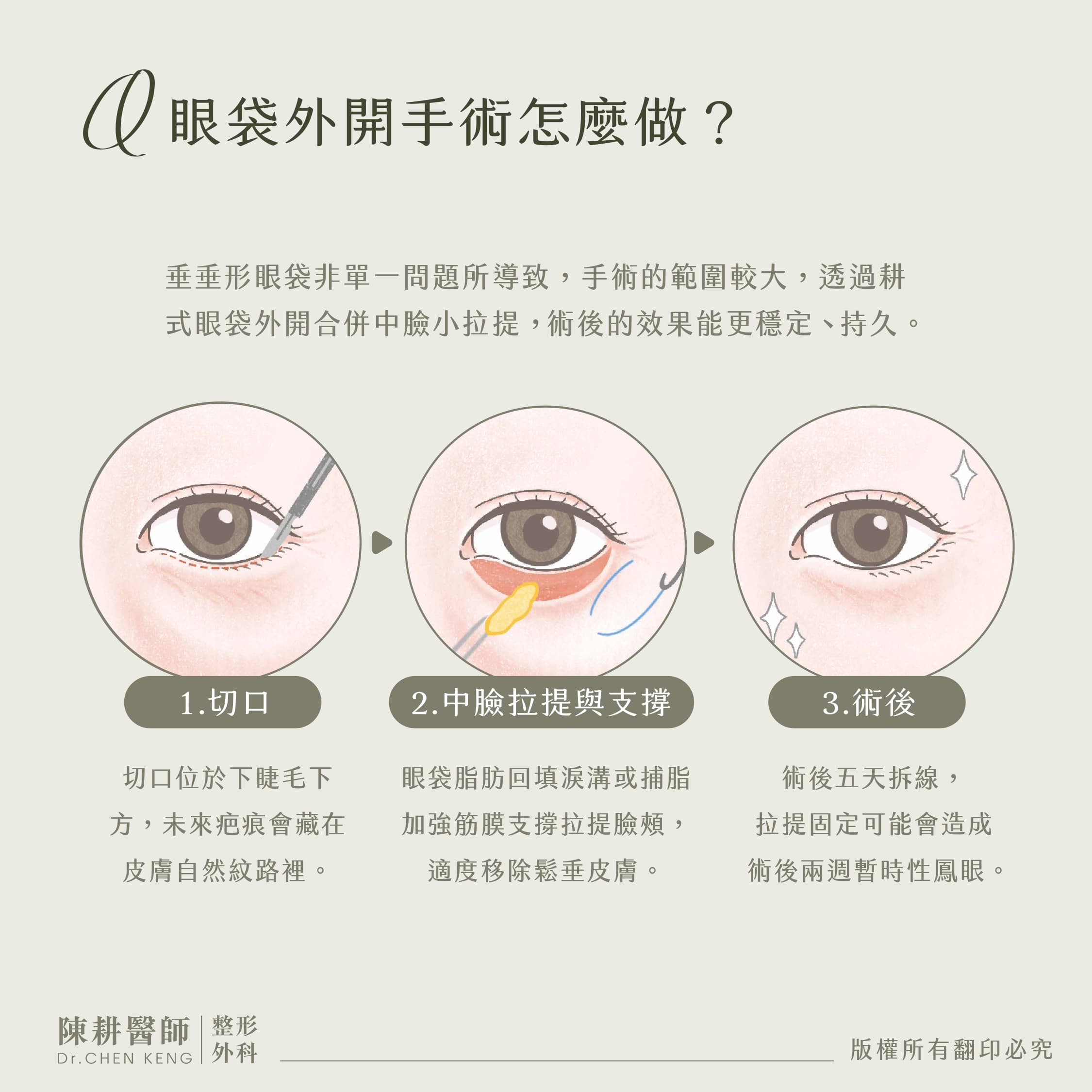 眼袋外開合併中臉拉提