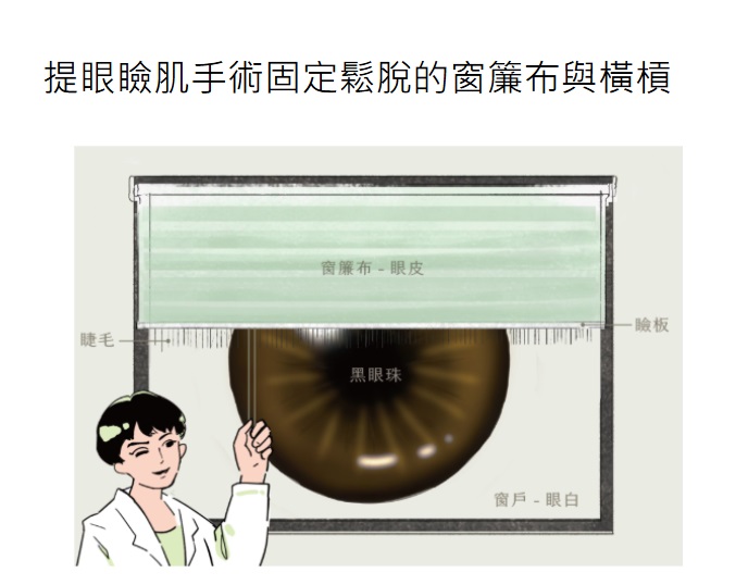 提眼瞼肌手術