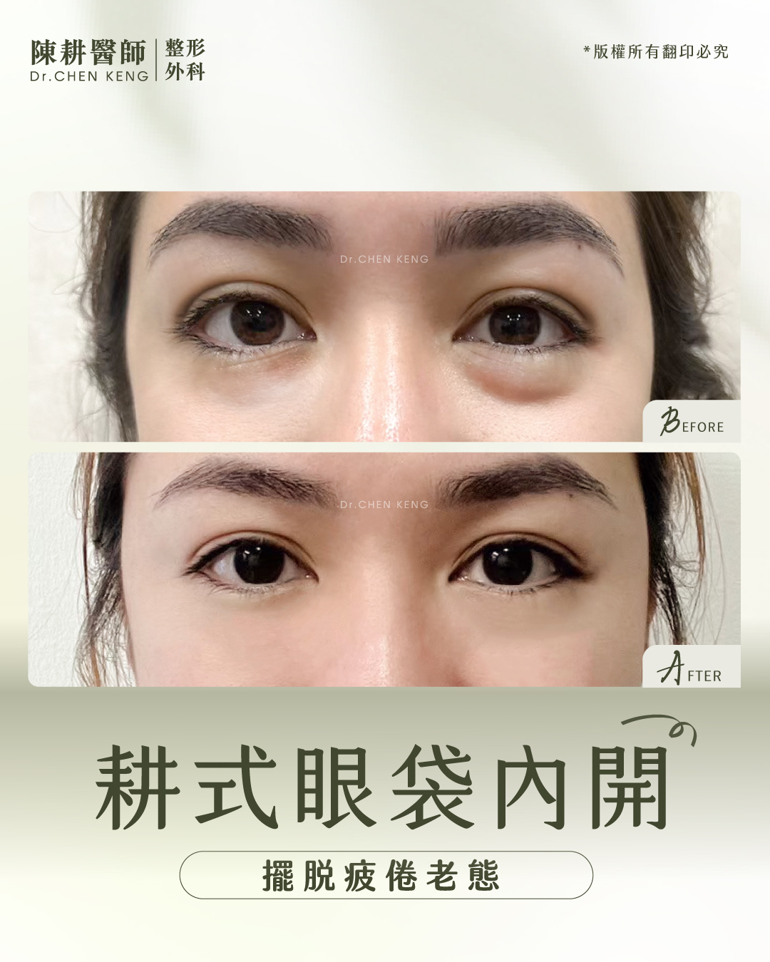眼袋手術臥蠶會不見嗎?