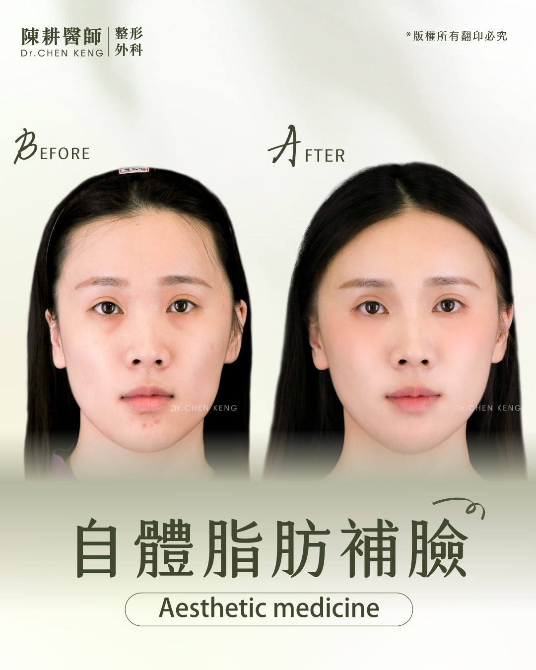 自體脂肪補臉缺點