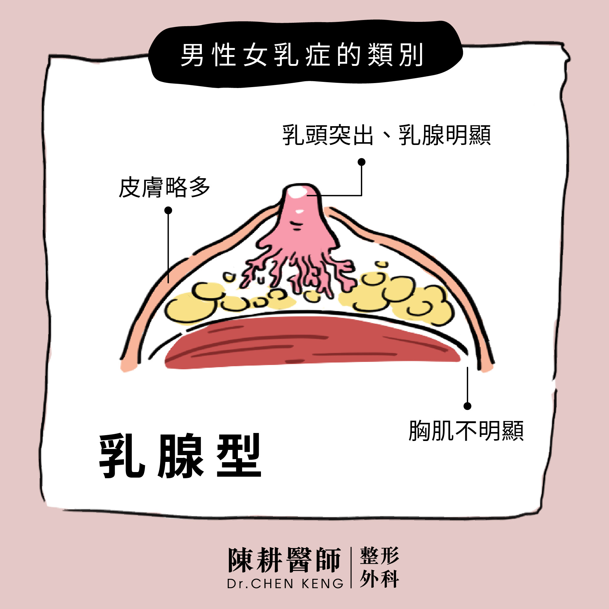 男性女乳症手術